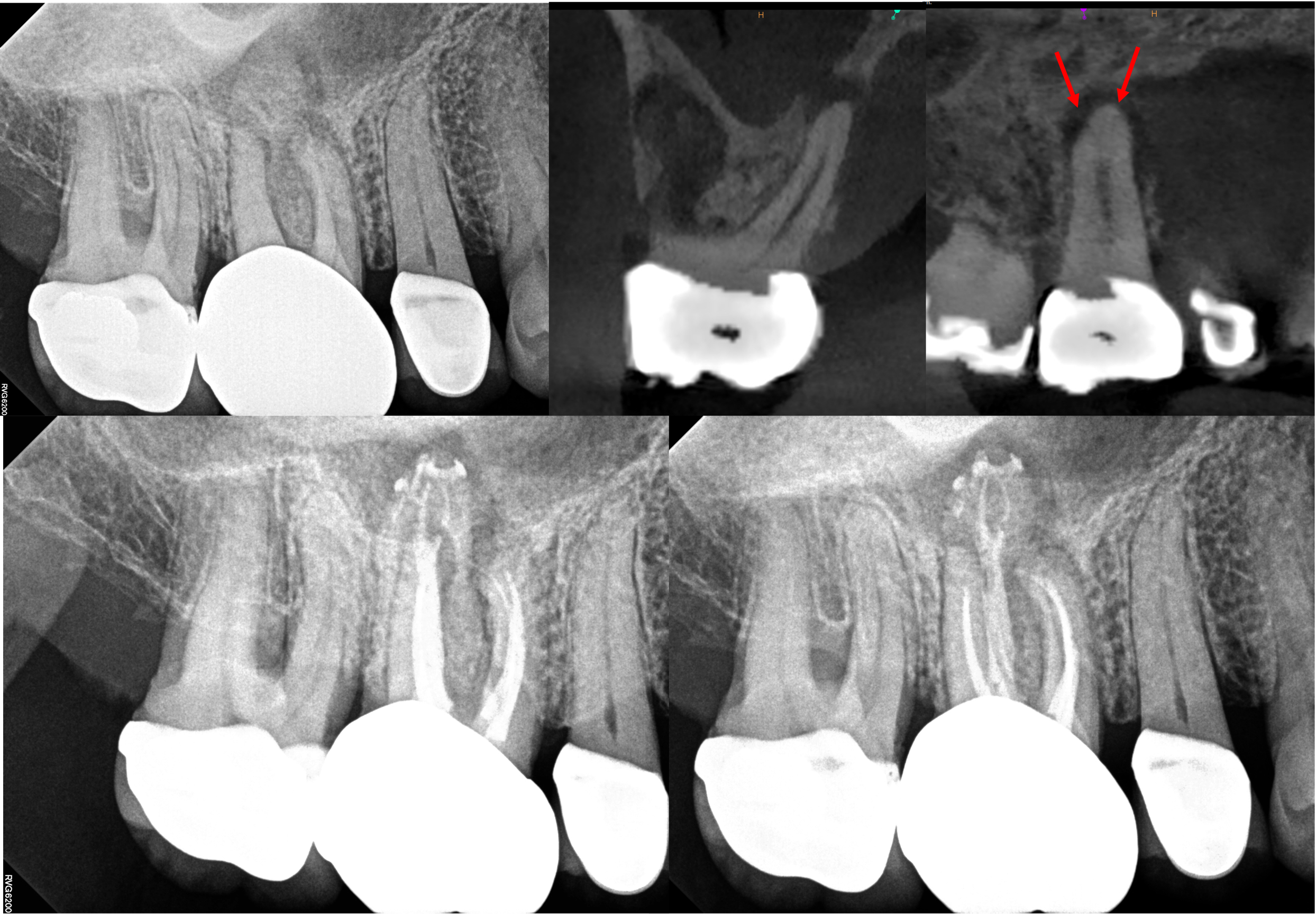 Complex Anatomy with Healing Evidence