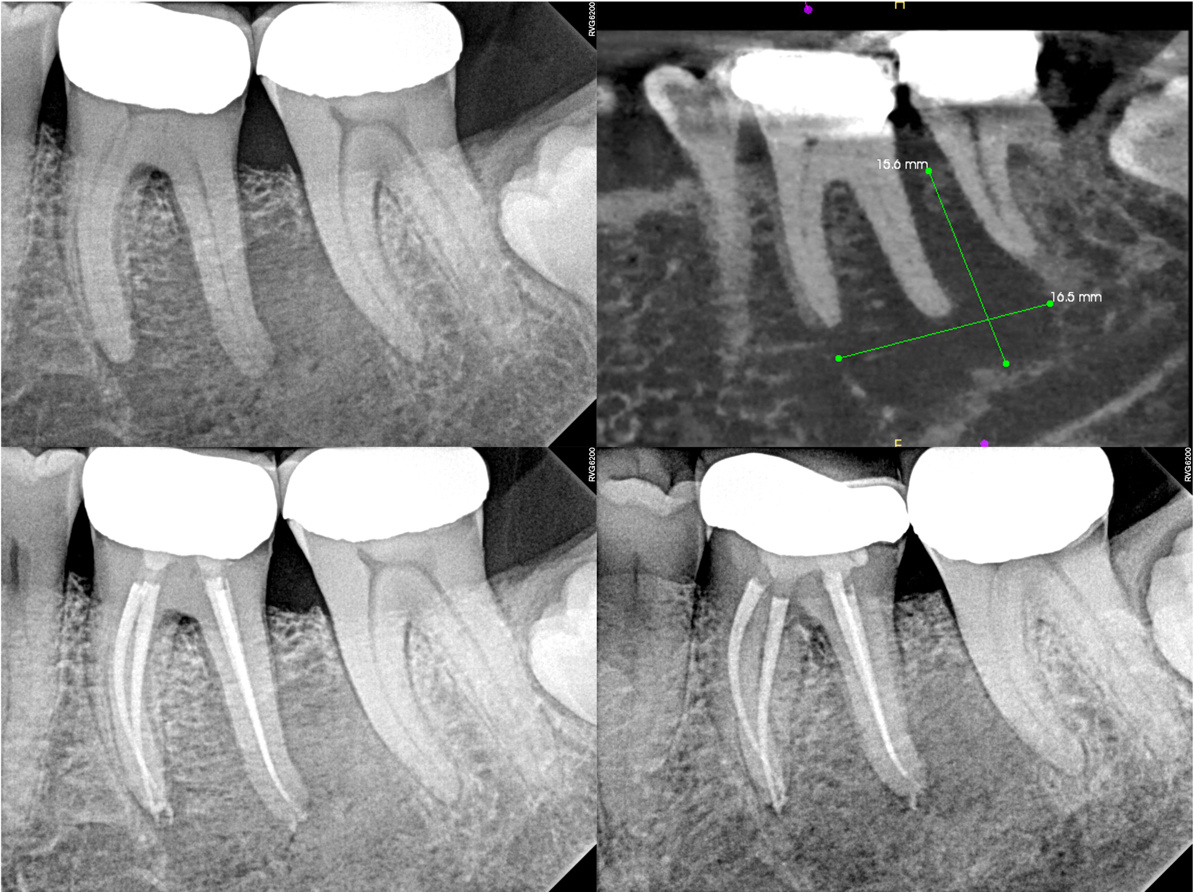 Guarded Pre - Op with Healing Evidence
