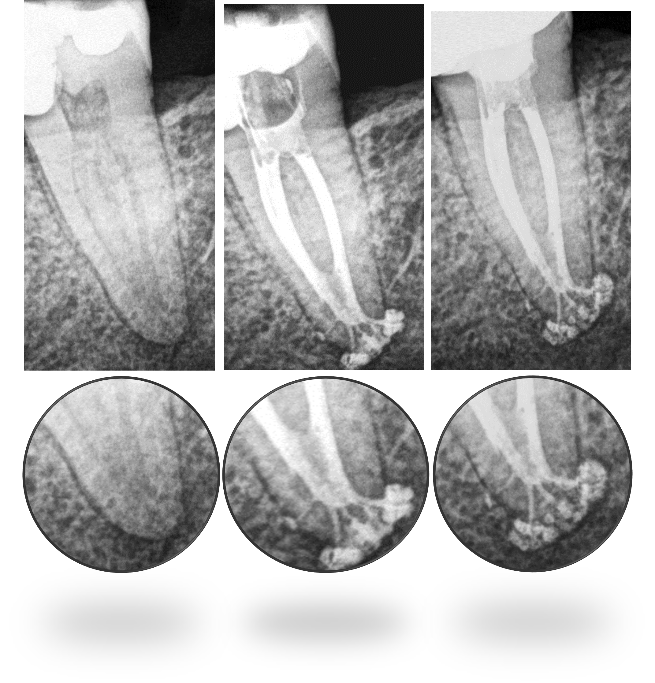 Apical Complex Anatomy with 1 Year Healing Evidence