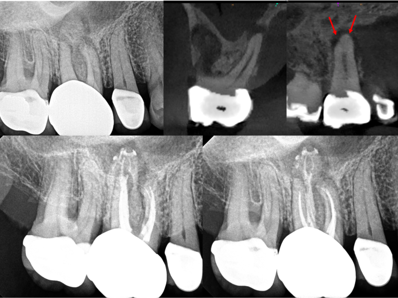 Complex Anatomy with Healing Evidence