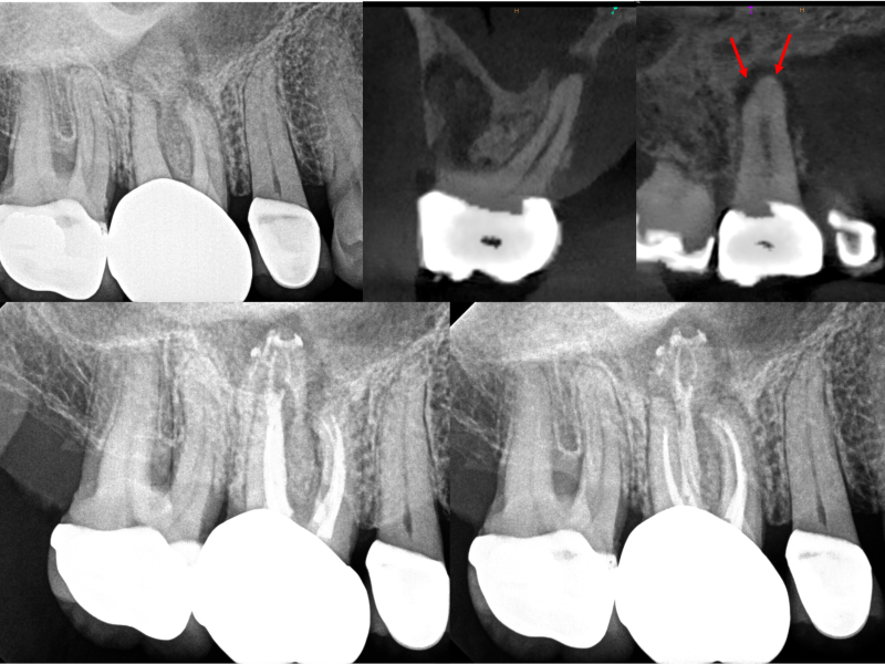 Complex Anatomy with Healing Evidence
