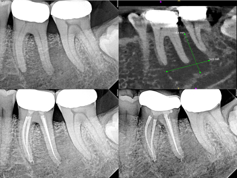 Guarded Pre - Op with Healing Evidence