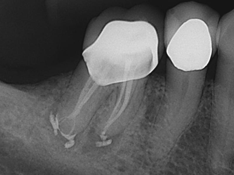 Calcified Canals with Healing Evidence