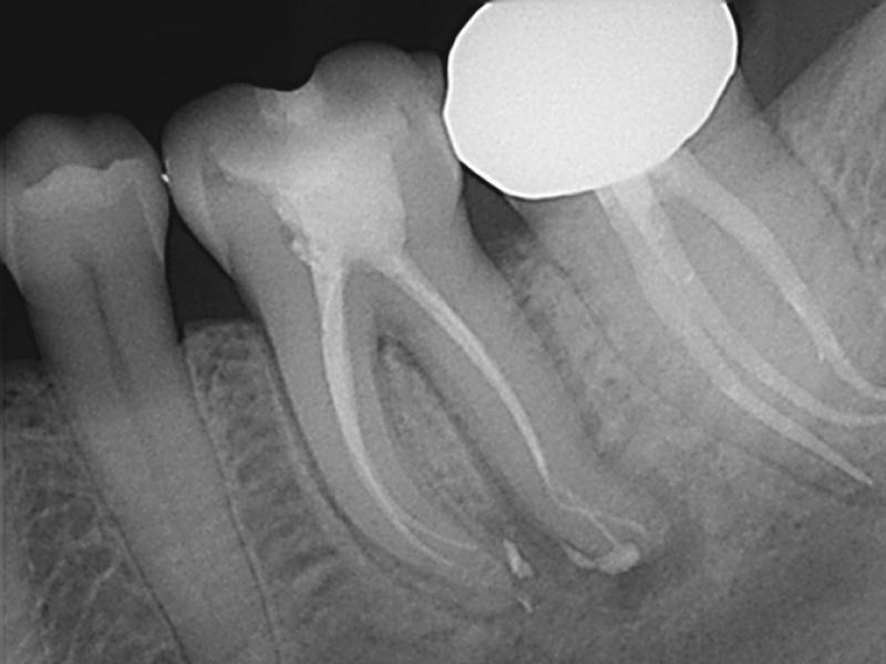 Guarded Pre-Op with 3 Months Healing Evidence