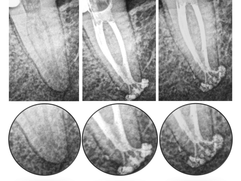 Apical Complex Anatomy with 1 Year Healing Evidence