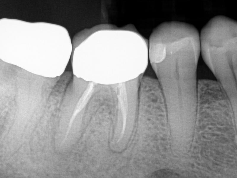 Guarded Pre-Op with Healing Evidence