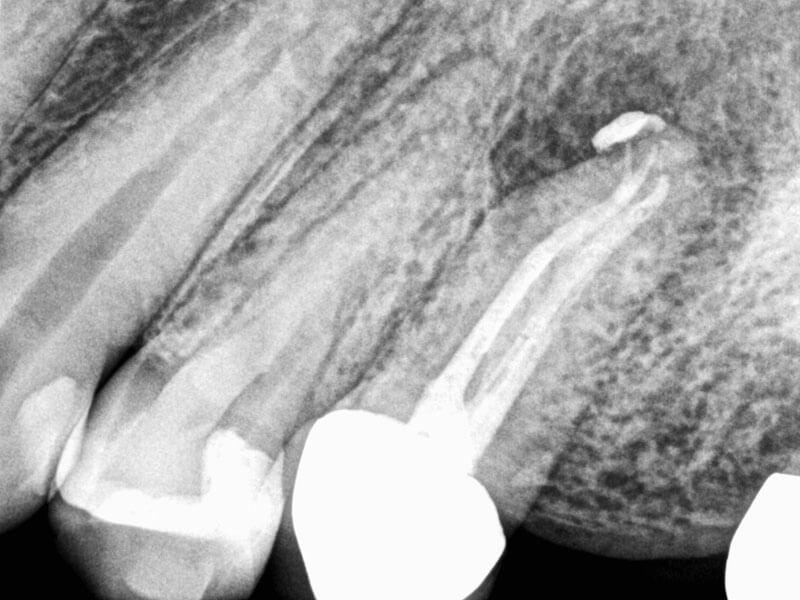 Retreatment with Acute Apical Abscess