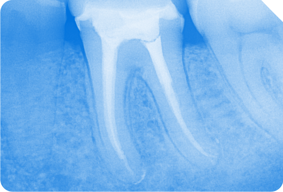 7x faster tissue dissolution rates